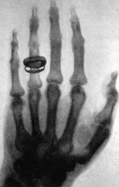 First radiological image. Röntgen´s wife´s hand